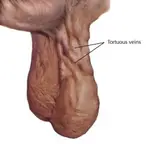 varicocele.jpg